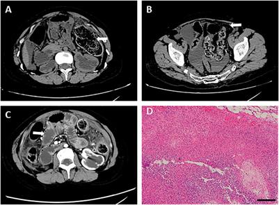 Case report: Multiple gastrointestinal perforations in a rare musculocontractural Ehlers–Danlos syndrome with multiple organ dysfunction